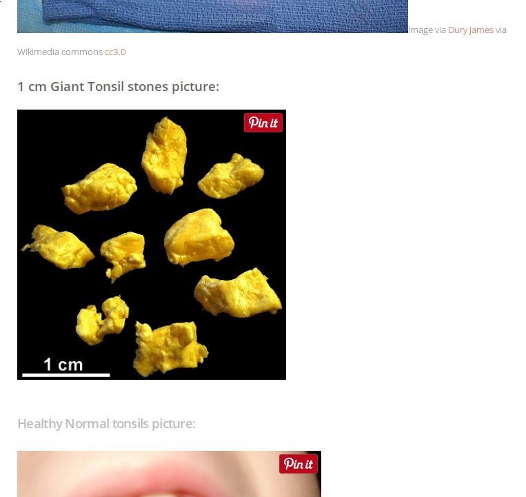 tonsil_stones_2