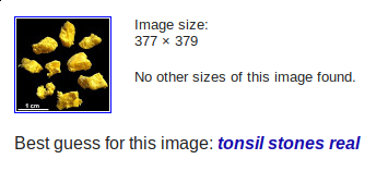 tonsil_stones_real